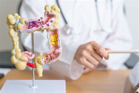 diverticulosis wikipedia|diverticulosis medical terminology.